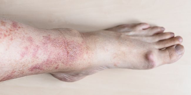 Comprendre l'eczéma : tout ce qu'il faut savoir pour mieux le vivre